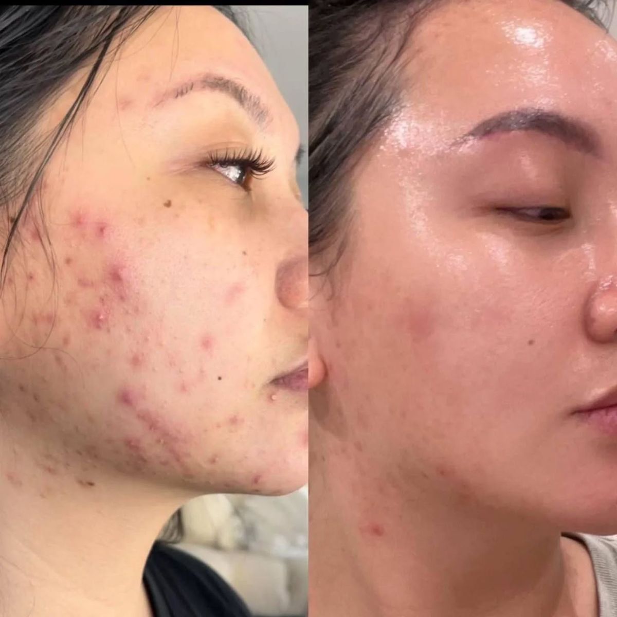 Sự Thật Về Thâm Mụn Ít Ai Nói